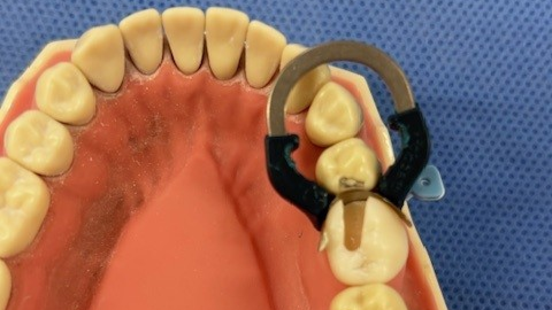 Posterior Composites: Mastering Matrix Systems, Wedges and Proximal Contacts