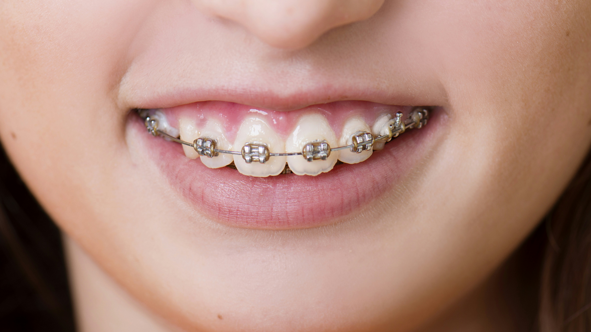 Interceptive Orthodontics