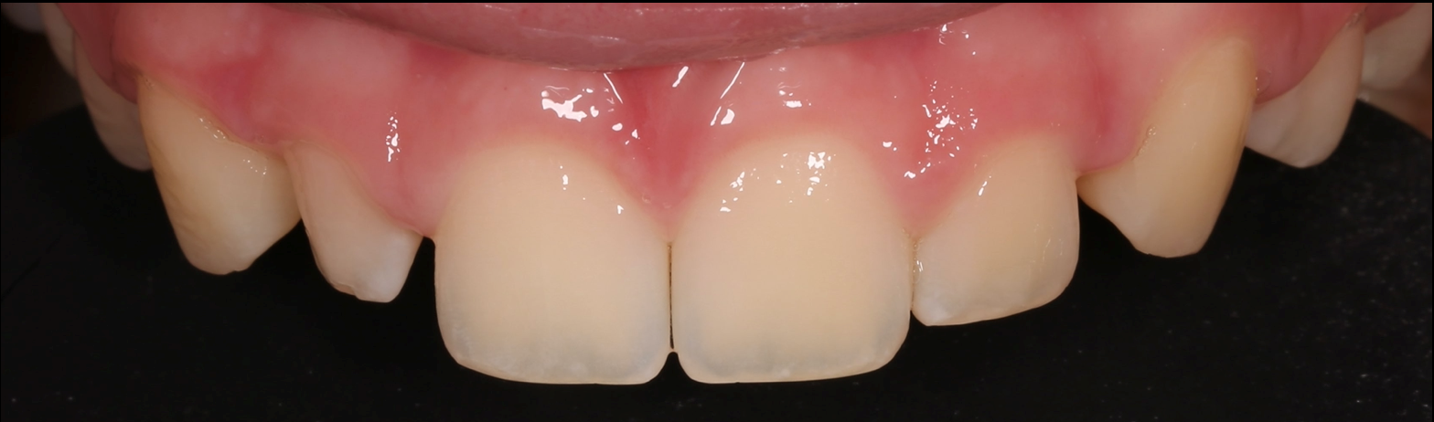 Composite to Restore Shape and Form