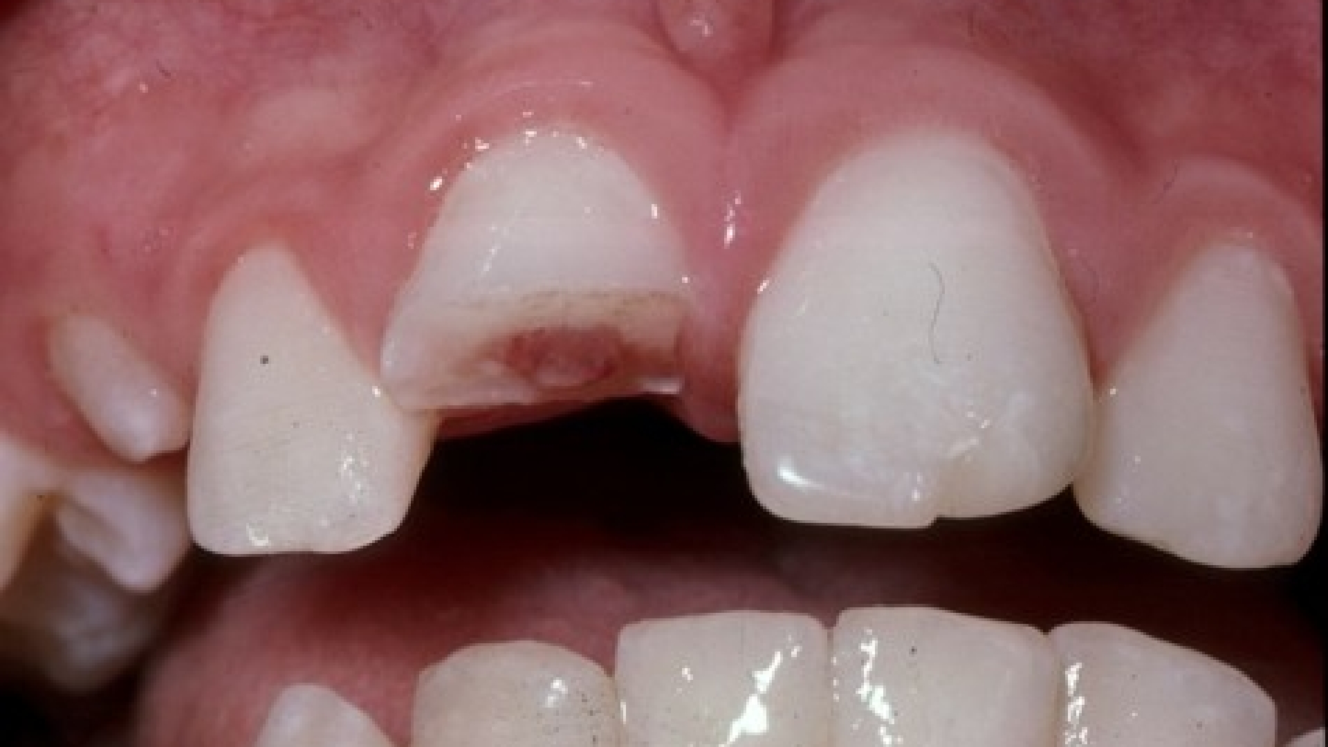Dental Trauma - Bunbury