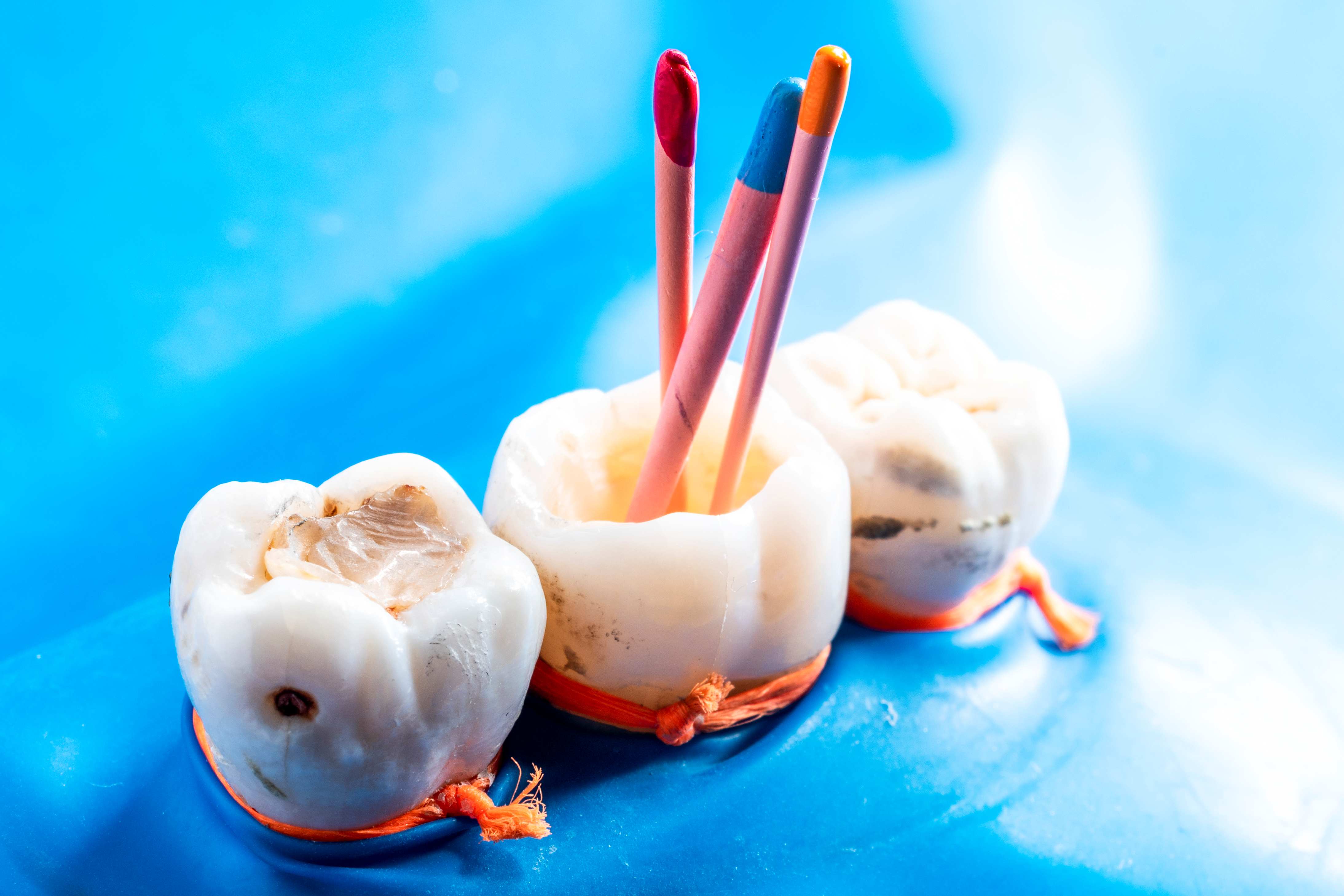 Management of Curved, Calcified and Complex Canal Systems