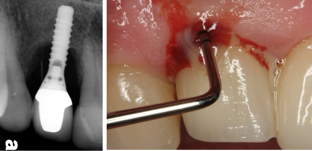 Patient-centred Contemporary Peri-Implantitis Treatment