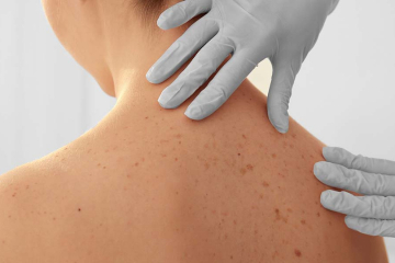 Melanoma & You: A Guide for New Zealanders